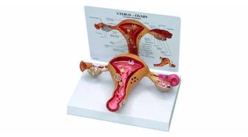 Модель заболеваний матки / матка и яичники